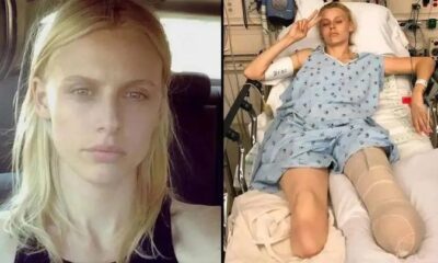 Tragedy strikes: American model loses legs and almost dies despite proper tampon use! …See More