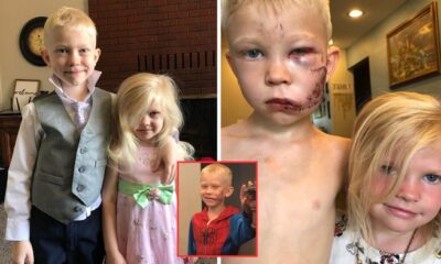 Incredible: Boy gets 90 stitches for protecting his sister from being bitten by a vicious dog, don’t skip without giving him some love…See more