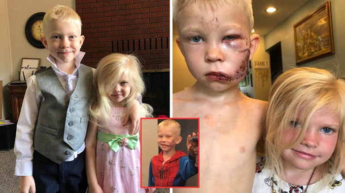 Incredible: Boy gets 90 stitches for protecting his sister from being bitten by a vicious dog, don’t skip without giving him some love…See more